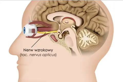 Przekrój głowy ukazujący oko i mózg. Strzałka wskazuje nerw wzrokowy, którego zapalenie może prowadzić do problemów ze wzrokiem.