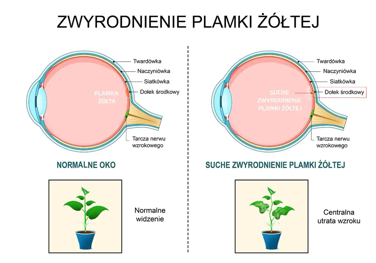 Zwyrodnienie plamki żółtej (AMD) - Objawy, leczenie, profilaktyka